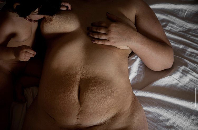 Foto van moeder met keizersnedelitteken en kindje aan de borst