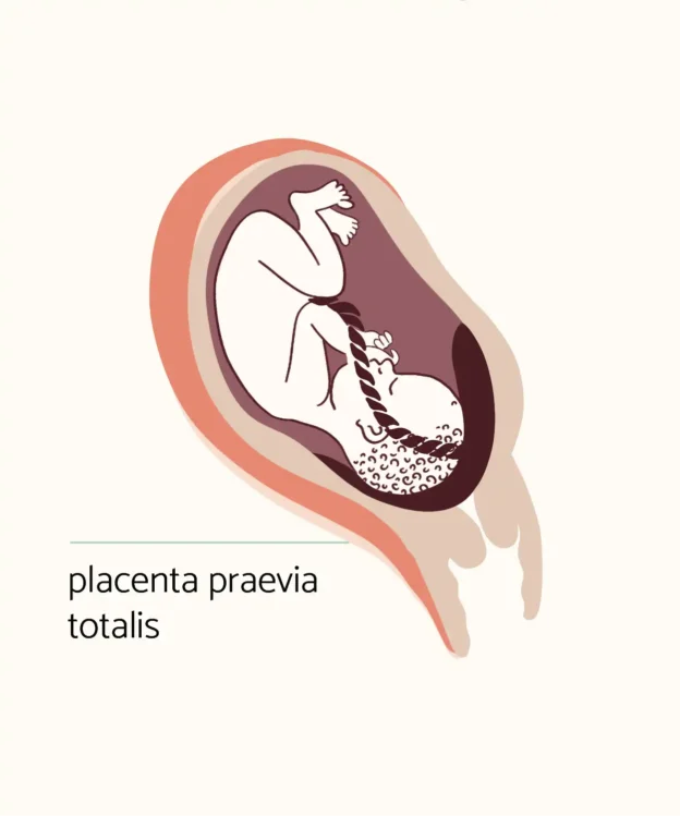 Placenta praevia totalis